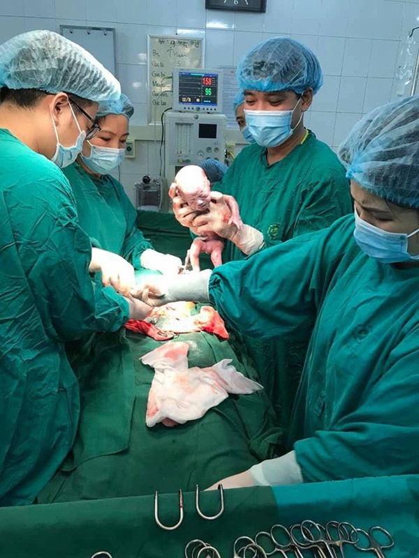 Mẹ trẻ ở Tuyên Quang sinh 3 bé trai giống hệt nhau, hiếm đến mức 200 triệu ca mới có 1-1