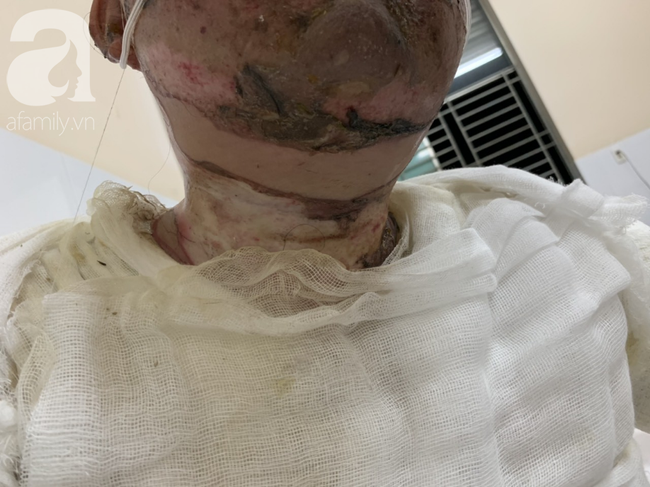 Bố dùng xăng đốt khiến mẹ biến dạng khuôn mặt, con gái 8 tuổi khóc ngất: Mẹ có xấu nhưng con vẫn nhận ra mẹ mà-8