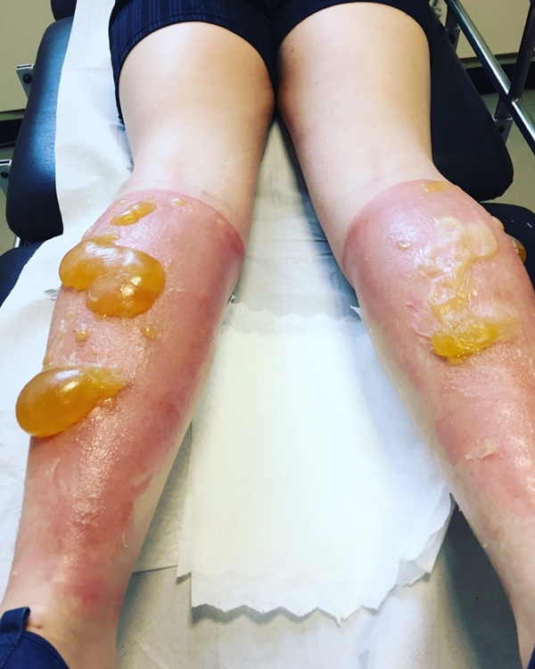 Bỏng do đi nắng: Nghe tưởng đùa nhưng bạn hãy xem những hình ảnh choáng váng này đi và nai nịt cẩn thận khi Hà Nội đang nắng cao điểm-5