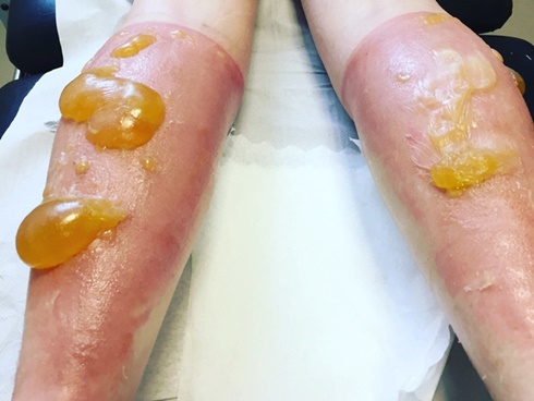 Bỏng axit: Cần sơ cứu nhanh theo các bước này để cứu nạn nhân-4