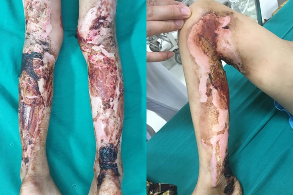 Chân bé trai bốc mùi hôi thối, nguy hiểm tính mạng do sai lầm của cha mẹ-1