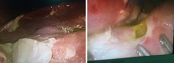 Bác sĩ cảnh báo: Ngày càng nhiều trẻ em bị thủng, loét dạ dày vì thói quen ăn uống tưởng chừng vô hại mà cha mẹ vẫn để con làm-1