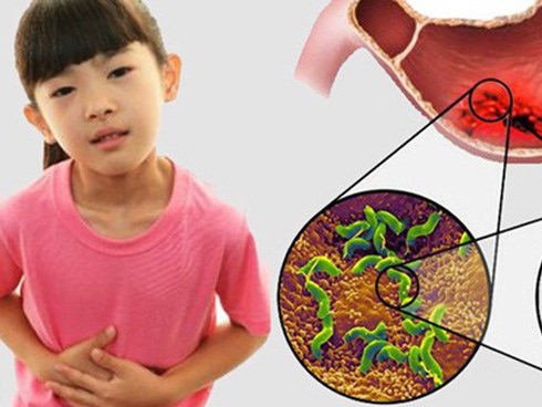 Bác sĩ cảnh báo: Ngày càng nhiều trẻ em bị thủng, loét dạ dày vì thói quen ăn uống tưởng chừng vô hại mà cha mẹ vẫn để con làm