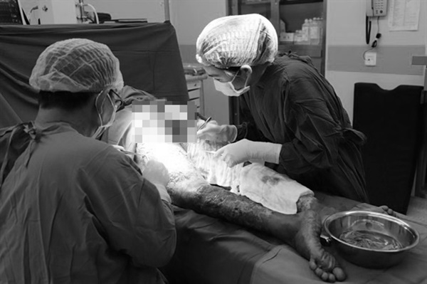 Bỏ qua vết xước nhỏ, cô giáo suy thận sau khi làm thịt lợn-2