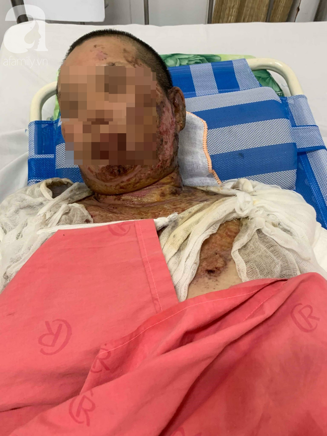 Phẫn nộ: Chồng nhậu say rồi về gây sự, mua xăng đốt vợ khiến nạn nhân bị bỏng nặng-1