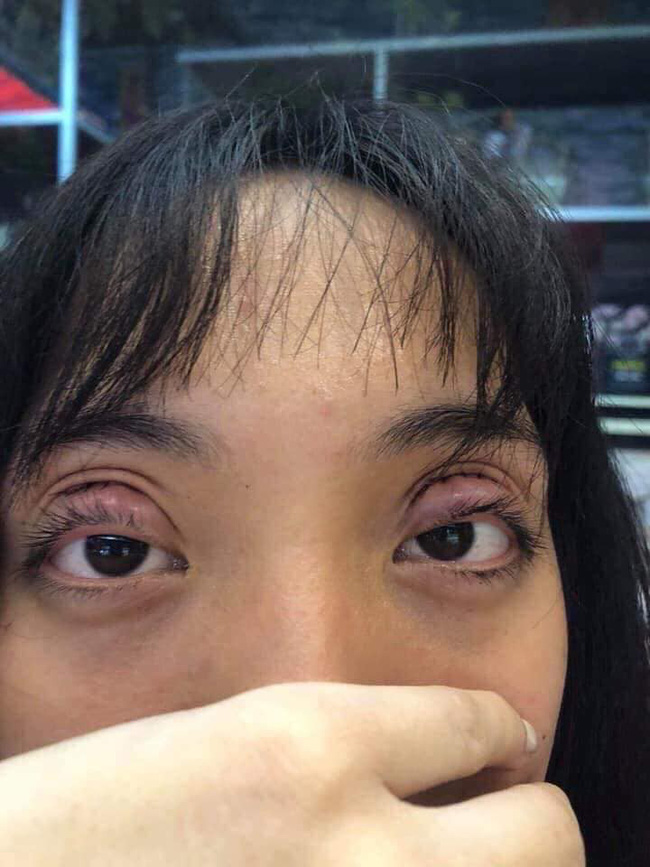 Háo hức bỏ tiền đi cắt mí mắt, mẹ trẻ nhận về đôi mí cách xa cả vạn dặm, đi ngủ không thể nhắm lại được-1