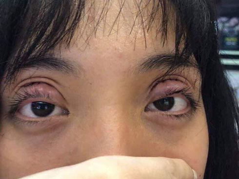 Cắt mí giúp mắt đẹp hơn nhưng làm không đúng bước này thì dễ rơi vào cảnh mắt xếch, mắt trợn ngược-3