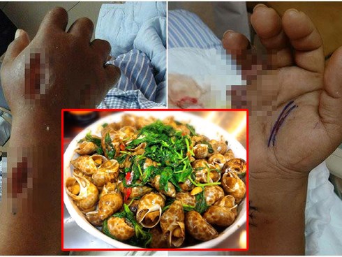 2 người phụ nữ tử vong sau khi ăn hải sản: Hãy cẩn trọng và đừng bao giờ ăn hải sản kiểu này