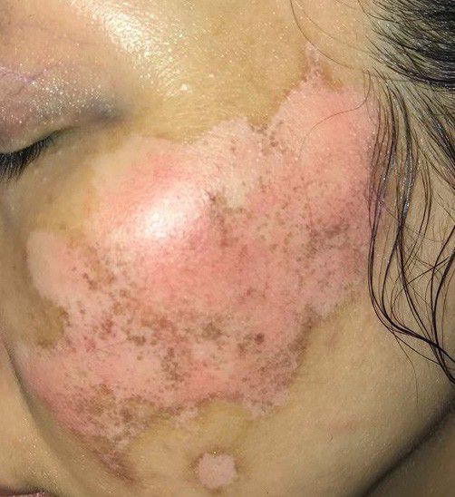 Ham rẻ, dùng phải mỹ phẩm giả đội lốt” hàng xách tay nhiều chị em bị hủy hoại biến dạng gương mặt kinh hoàng-3