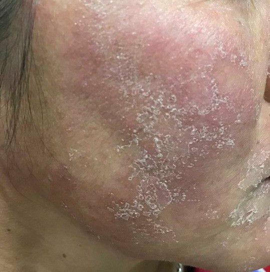 Ham rẻ, dùng phải mỹ phẩm giả đội lốt” hàng xách tay nhiều chị em bị hủy hoại biến dạng gương mặt kinh hoàng-4