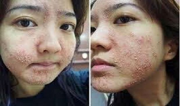Ham rẻ, dùng phải mỹ phẩm giả đội lốt” hàng xách tay nhiều chị em bị hủy hoại biến dạng gương mặt kinh hoàng-5
