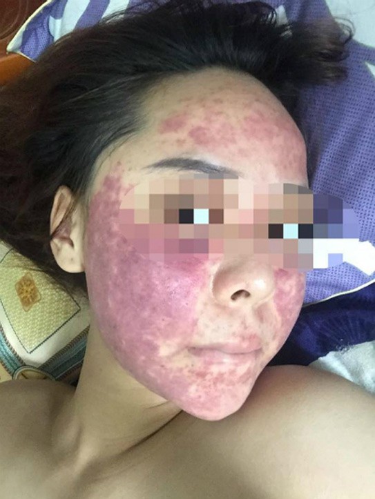 Ham rẻ, dùng phải mỹ phẩm giả đội lốt” hàng xách tay nhiều chị em bị hủy hoại biến dạng gương mặt kinh hoàng-6