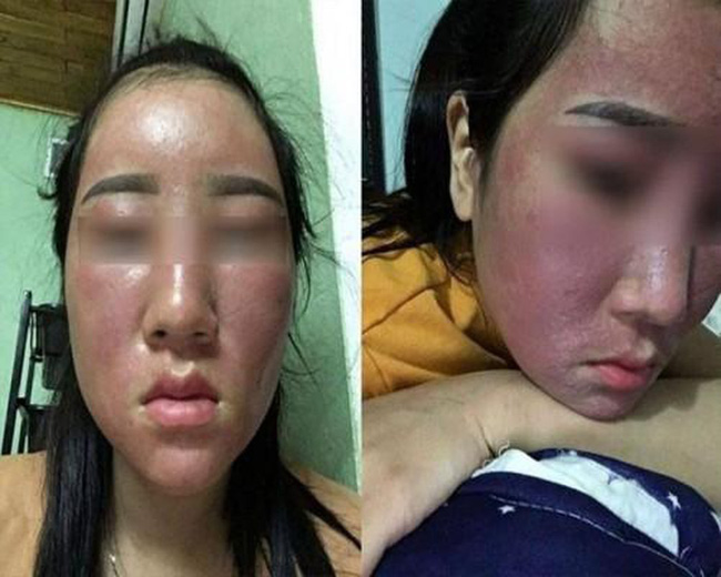 Ham rẻ, dùng phải mỹ phẩm giả đội lốt” hàng xách tay nhiều chị em bị hủy hoại biến dạng gương mặt kinh hoàng-7