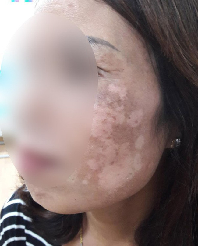 Ham rẻ, dùng phải mỹ phẩm giả đội lốt” hàng xách tay nhiều chị em bị hủy hoại biến dạng gương mặt kinh hoàng-8