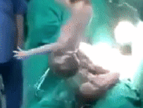 Người mẹ mang thai 5 cực hiếm, lúc lâm bồn các bác sĩ choáng váng khi nhìn thấy điều này vào phút cuối