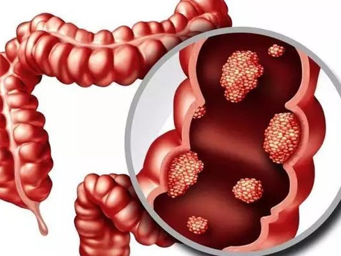Thói quen khiến nhiều người xấu hổ nhưng nếu không biết, cẩn thận có thể bị ung thư-3