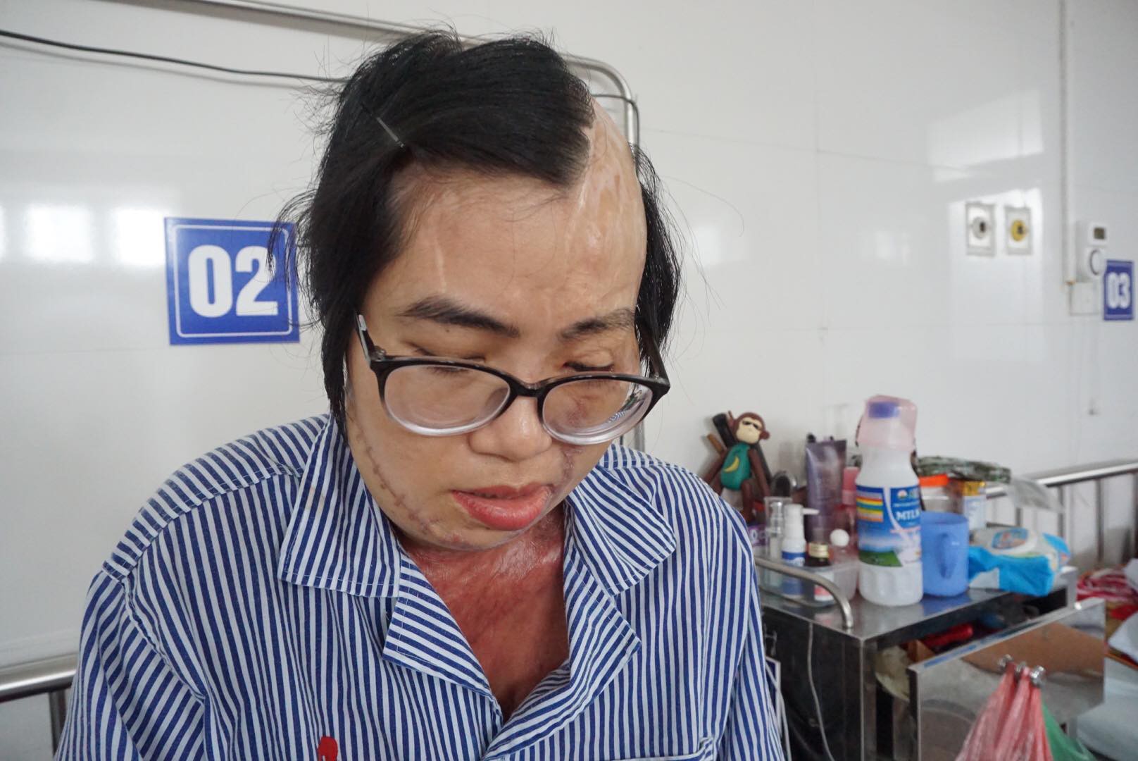 Cô giáo bị chồng tạt axit biến dạng khuôn mặt và tâm sự chua xót của người cha sau 21 lần phẫu thuật của con gái-4