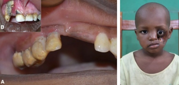 Noma - Căn bệnh kinh hoàng nhất thế giới, chỉ có 15% trẻ em sống sót sau cơn đau cấp tính-1