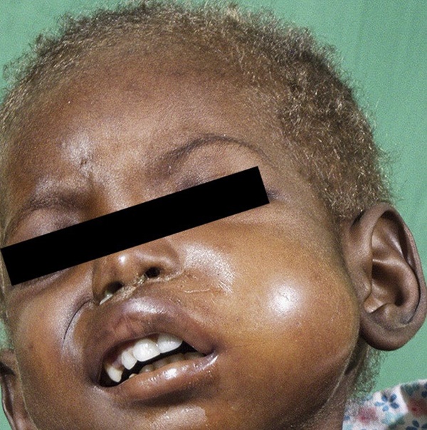 Noma - Căn bệnh kinh hoàng nhất thế giới, chỉ có 15% trẻ em sống sót sau cơn đau cấp tính-2