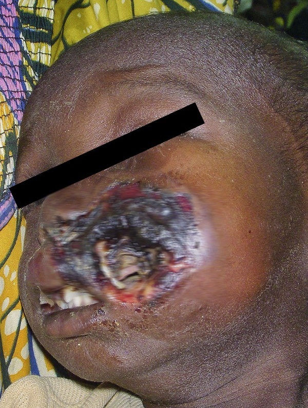 Noma - Căn bệnh kinh hoàng nhất thế giới, chỉ có 15% trẻ em sống sót sau cơn đau cấp tính-3