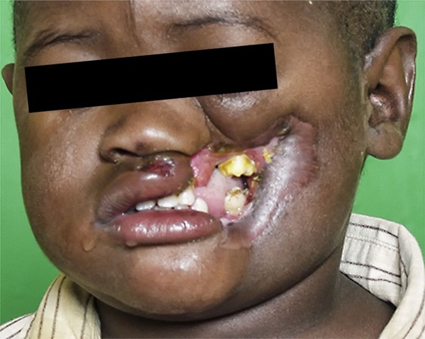 Noma - Căn bệnh kinh hoàng nhất thế giới, chỉ có 15% trẻ em sống sót sau cơn đau cấp tính-4