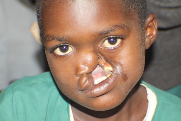 Noma - Căn bệnh kinh hoàng nhất thế giới, chỉ có 15% trẻ em sống sót sau cơn đau cấp tính-5