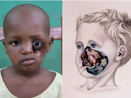 Noma - Căn bệnh kinh hoàng nhất thế giới, chỉ có 15% trẻ em sống sót sau cơn đau cấp tính