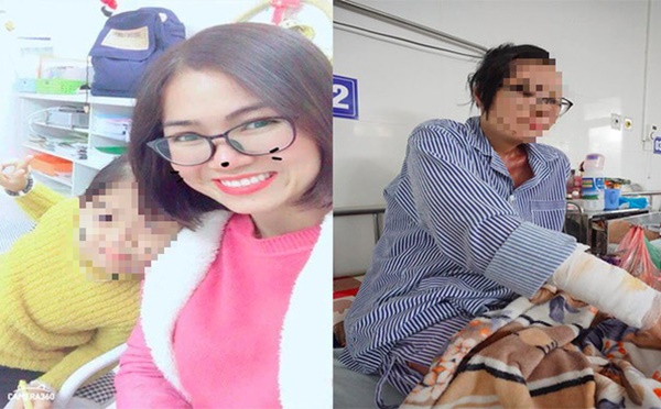 1 năm sau khi bị chồng cũ tạt axit, cô giáo Hà Nội xinh đẹp kể về 5 ngày chết lâm sàng, 21 lần ghép da-1