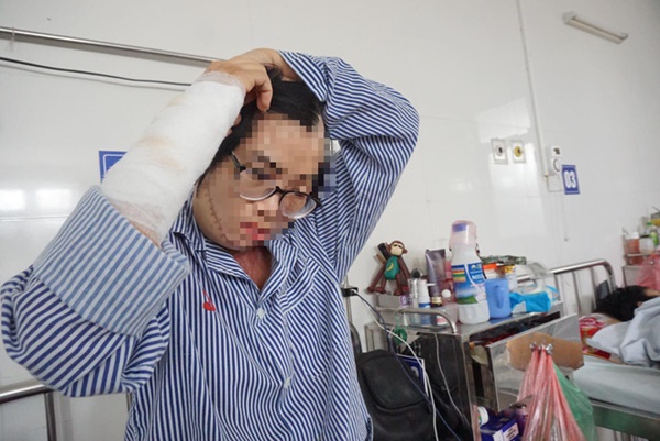 1 năm sau khi bị chồng cũ tạt axit, cô giáo Hà Nội xinh đẹp kể về 5 ngày chết lâm sàng, 21 lần ghép da-2