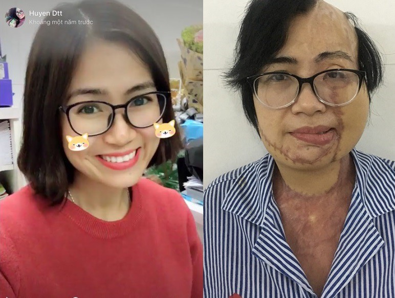 Cô giáo bị chồng tạt axit sau 21 lần phẫu thuật cay đắng nói về sai lầm trong hôn nhân nhiều người mắc phải-1