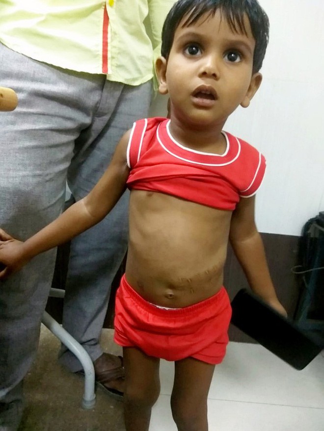 Bé trai sống sót kì diệu sau khi ngã từ nhà cao tầng và bị cây sắt dài 1,8m xuyên qua người-5