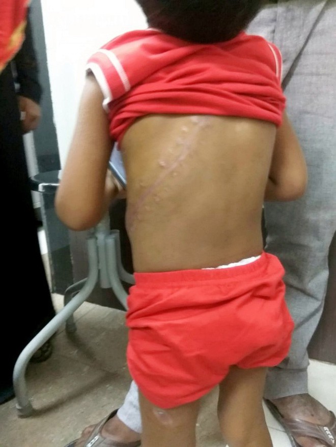 Bé trai sống sót kì diệu sau khi ngã từ nhà cao tầng và bị cây sắt dài 1,8m xuyên qua người-6