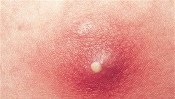 Cô gái 24 tuổi không dám ngồi ở nơi đông người, phải lót giấy vệ sinh trong quần vì căn bệnh đáng sợ-2