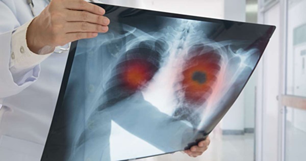 2 vợ chồng cùng mắc bệnh ung thư phổi: Lời cảnh tỉnh tới những người chồng đang bào mòn sức khỏe của người thân vì thói quen độc hại-1