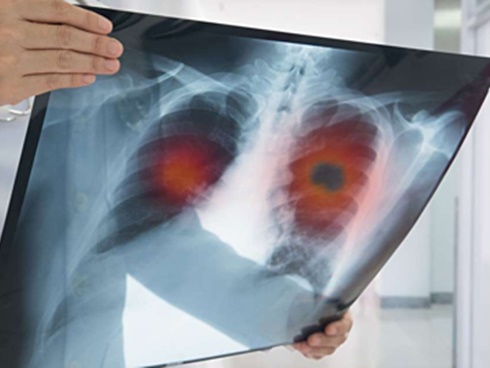 Cô gái 21 tuổi qua đời sau 5 ngày phát hiện ung thư, lời cảnh báo của chuyên gia-4