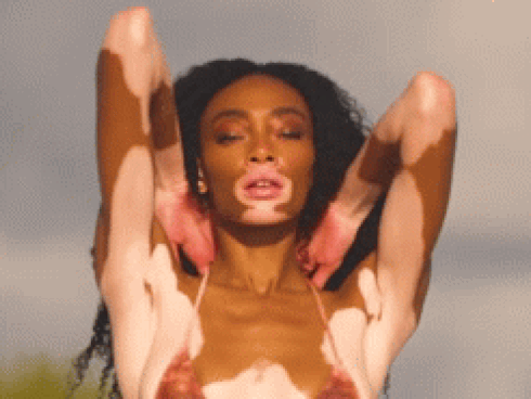 Winnie Harlow, từ cô gái bị chê xấu xí đến người mẫu được săn đón