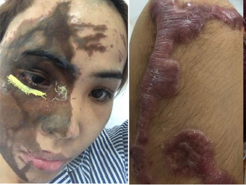 Cô gái bị chồng sắp cưới tạt axit đau đớn tiết lộ: Lời cuối cùng anh ta nói với bố em là Xem lại con gái ông đi-9