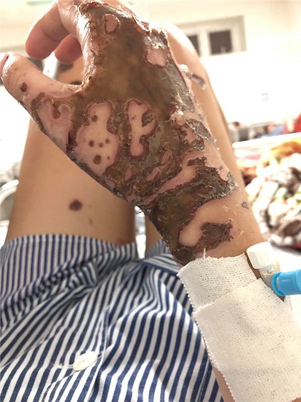 Cô gái bị chồng sắp cưới tạt axit đau đớn tiết lộ: Lời cuối cùng anh ta nói với bố em là Xem lại con gái ông đi-5