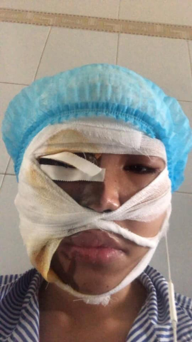 Nỗi đau tột cùng của cô gái bị chồng sắp cưới tạt axit biến dạng gương mặt: Đêm tôi không dám ngủ vì giây phút ấy lại hiện về-7