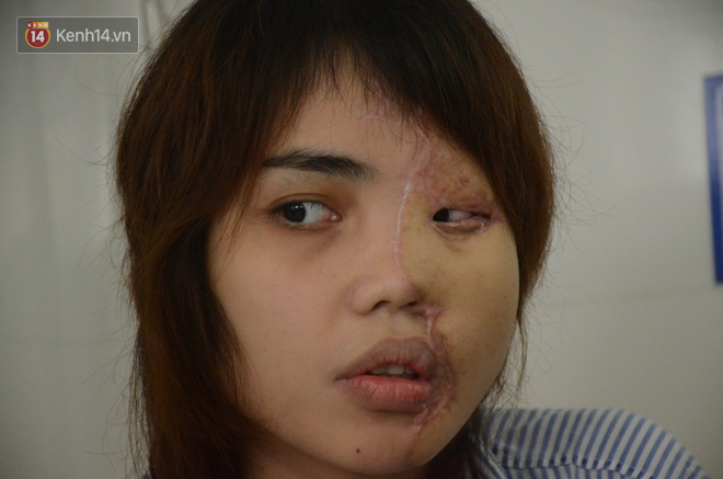 Nỗi đau tột cùng của cô gái bị chồng sắp cưới tạt axit biến dạng gương mặt: Đêm tôi không dám ngủ vì giây phút ấy lại hiện về-10