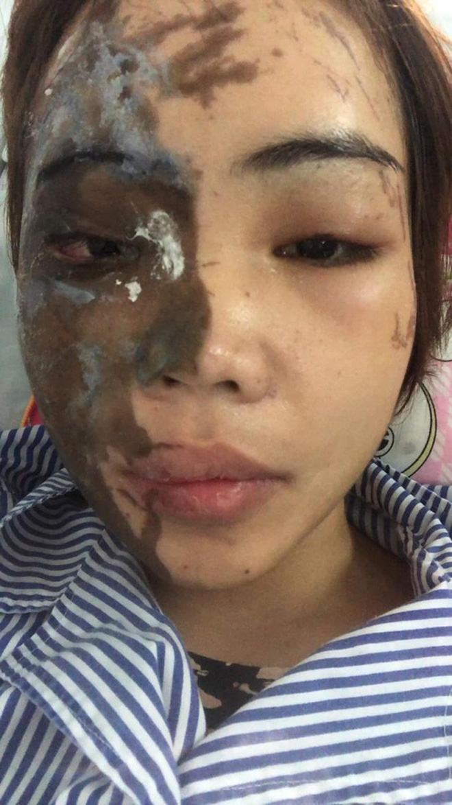 Nỗi đau tột cùng của cô gái bị chồng sắp cưới tạt axit biến dạng gương mặt: Đêm tôi không dám ngủ vì giây phút ấy lại hiện về-16
