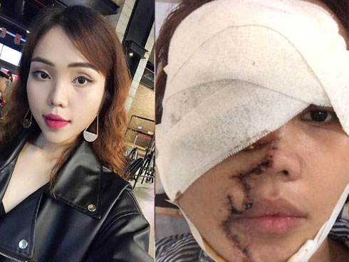 Bố của cô gái bị chồng sắp cưới tạt axit biến dạng gương mặt: Nó làm thế còn đau đớn hơn giết người-11