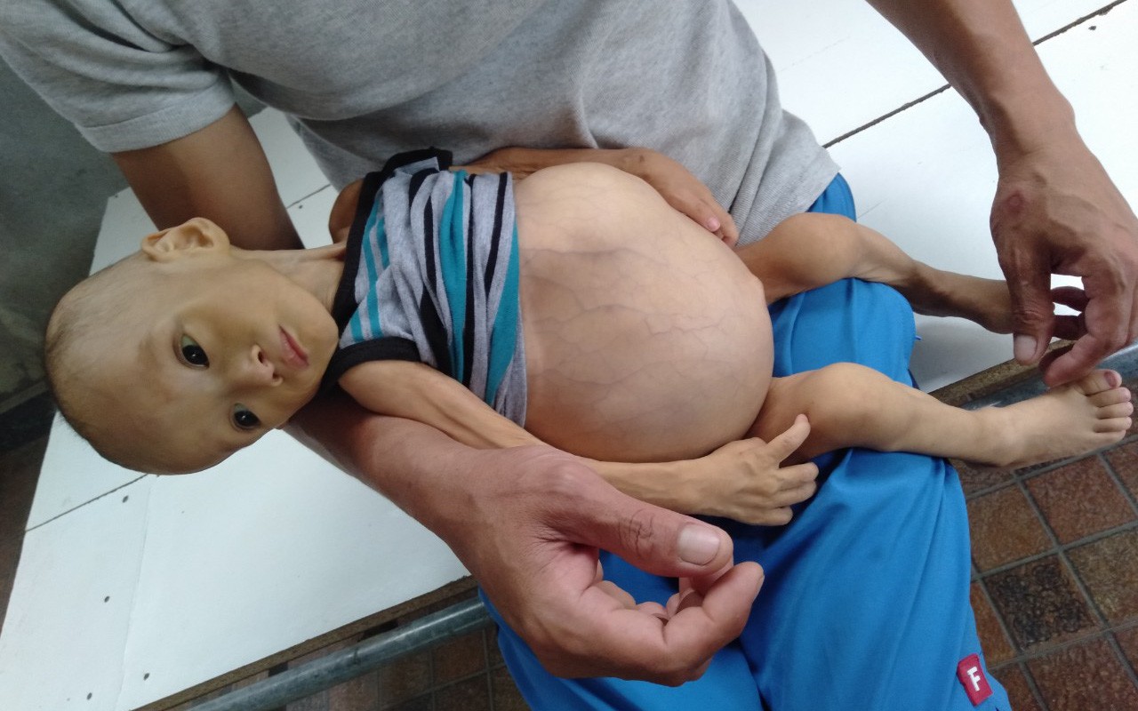 Sự sống mong manh của bé trai 1 tuổi, chỉ nặng 6kg, bụng phình to như cái trống mà mẹ nghèo không tiền chữa trị-1