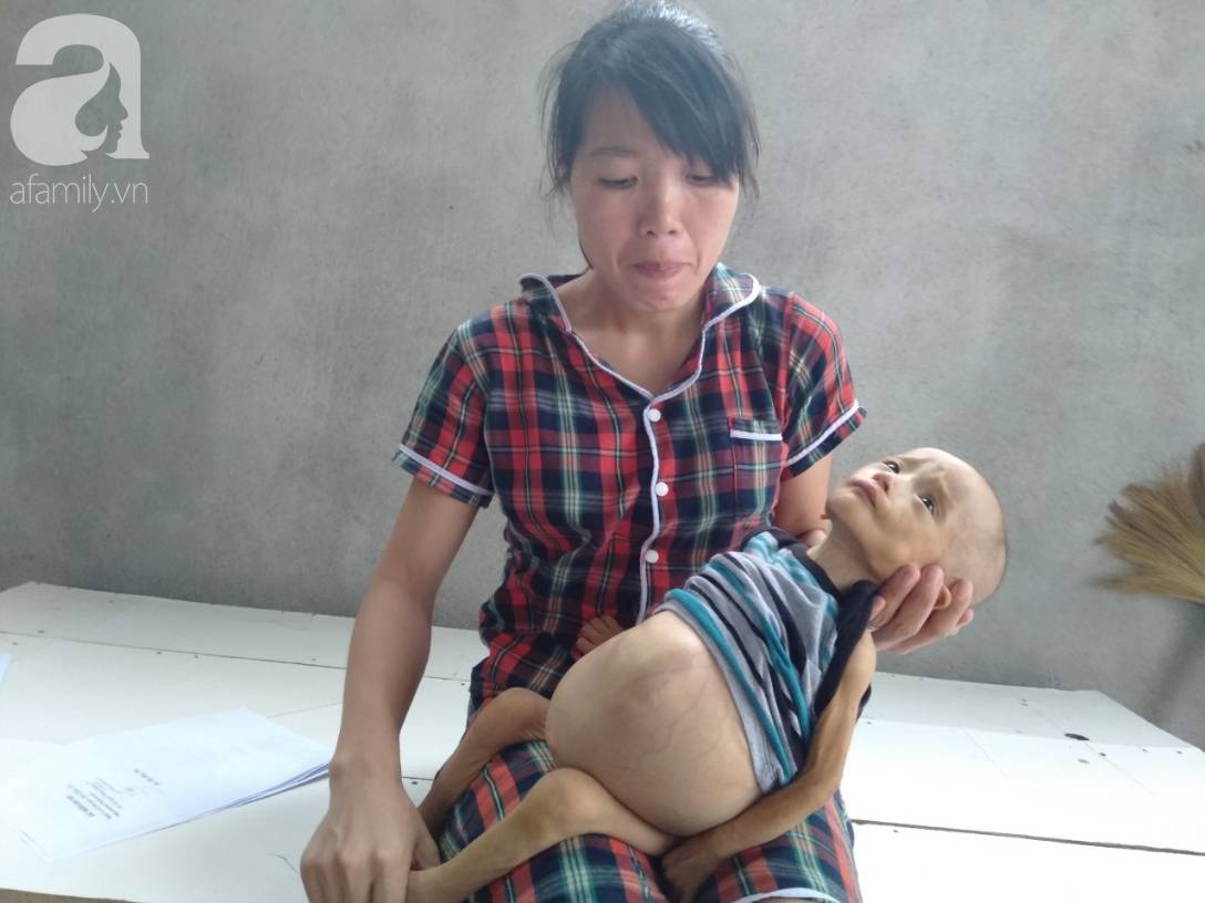Sự sống mong manh của bé trai 1 tuổi, chỉ nặng 6kg, bụng phình to như cái trống mà mẹ nghèo không tiền chữa trị-2
