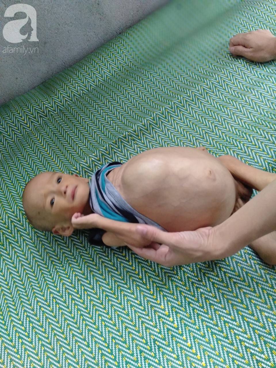 Sự sống mong manh của bé trai 1 tuổi, chỉ nặng 6kg, bụng phình to như cái trống mà mẹ nghèo không tiền chữa trị-10