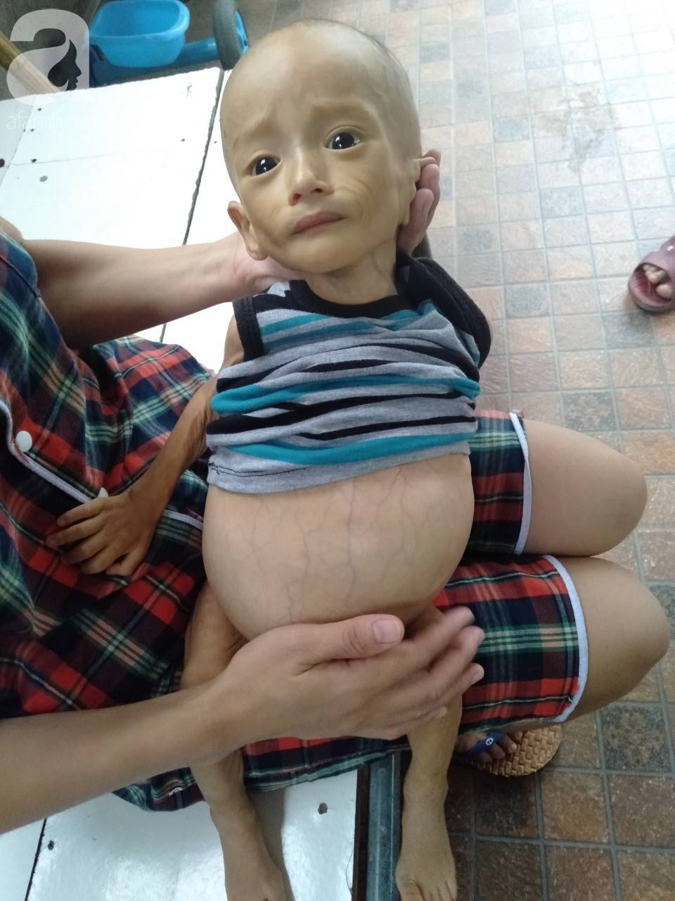 Sự sống mong manh của bé trai 1 tuổi, chỉ nặng 6kg, bụng phình to như cái trống mà mẹ nghèo không tiền chữa trị-11