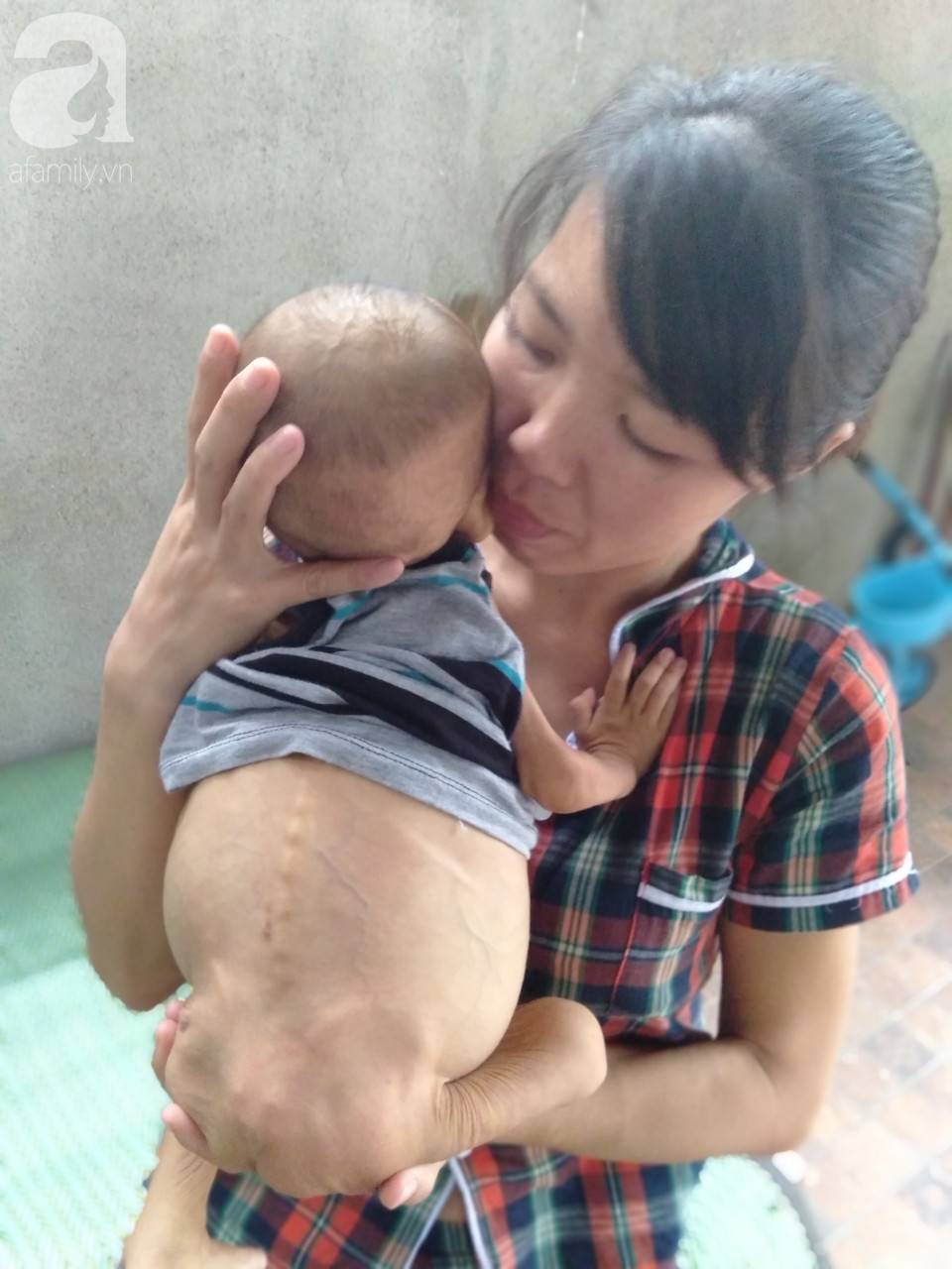 Sự sống mong manh của bé trai 1 tuổi, chỉ nặng 6kg, bụng phình to như cái trống mà mẹ nghèo không tiền chữa trị-6
