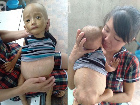 Sự sống mong manh của bé trai 1 tuổi, chỉ nặng 6kg, bụng phình to như cái trống mà mẹ nghèo không tiền chữa trị