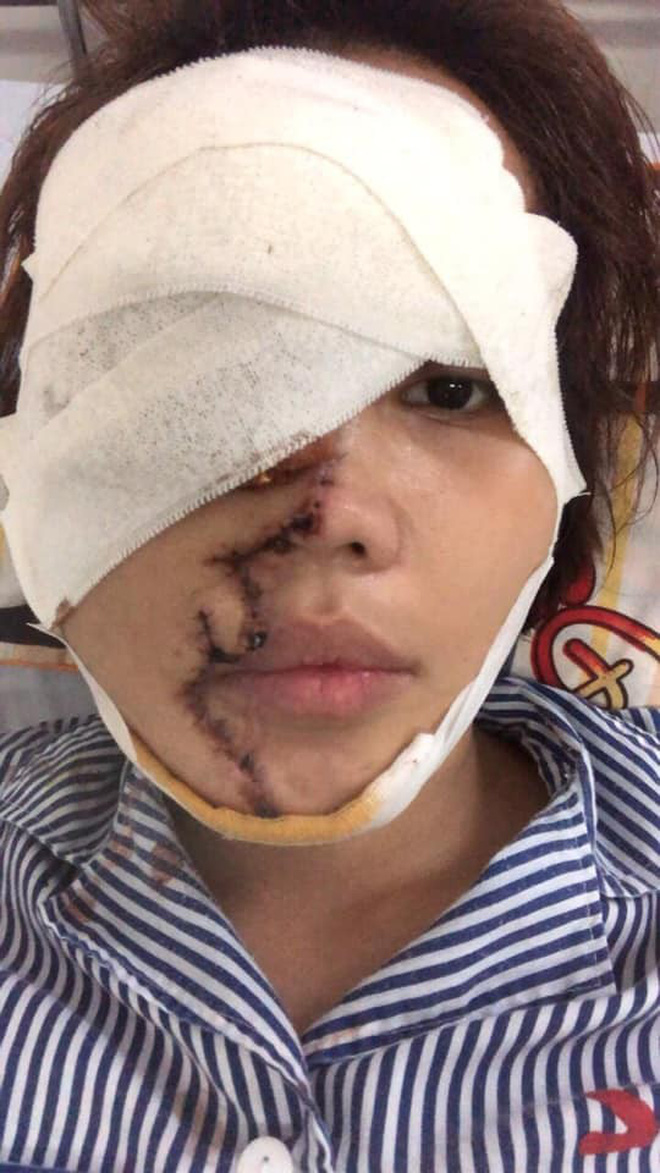 Bố của cô gái bị chồng sắp cưới tạt axit biến dạng gương mặt: Nó làm thế còn đau đớn hơn giết người-5