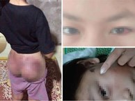 Nghi trộm tiền, bé gái ở Hà Tĩnh bị công an viên đánh bầm tím
